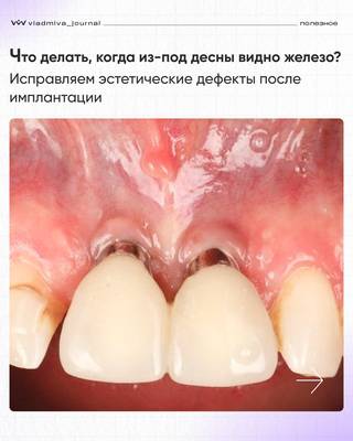 Расхождение мягких тканей: успешное лечение по методу Тавелли.